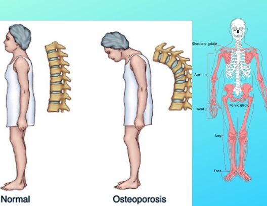 osteoporosis  ... healthy-myself.com