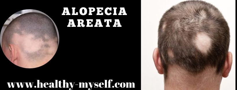 What is Alopecia Areata... Healthy-myself.com