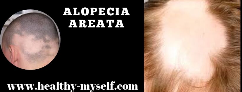 Alopecia Areata... Healthy-myself.com