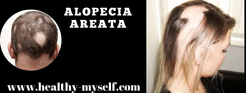 Alopecia Areata /Healthy-myself.com