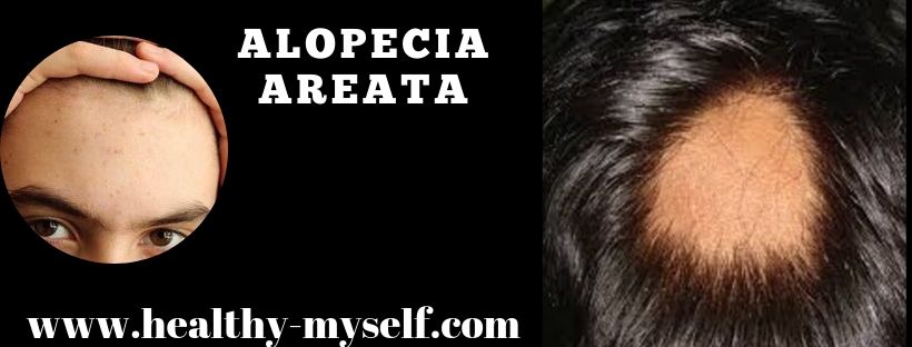 Alopecia Areata Type ... Healthy-myself.com