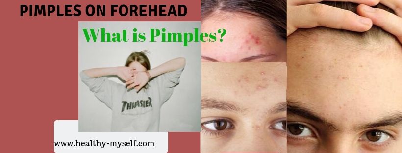 Pimples On Forehead-What is Pimples?