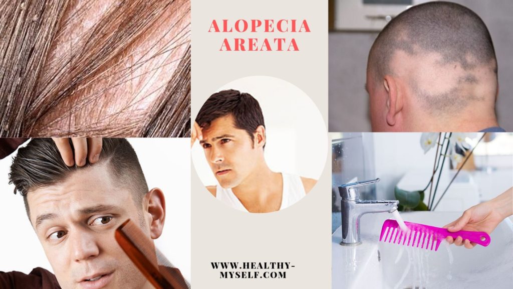 Alopecia Picture ... Healthy-myself.com