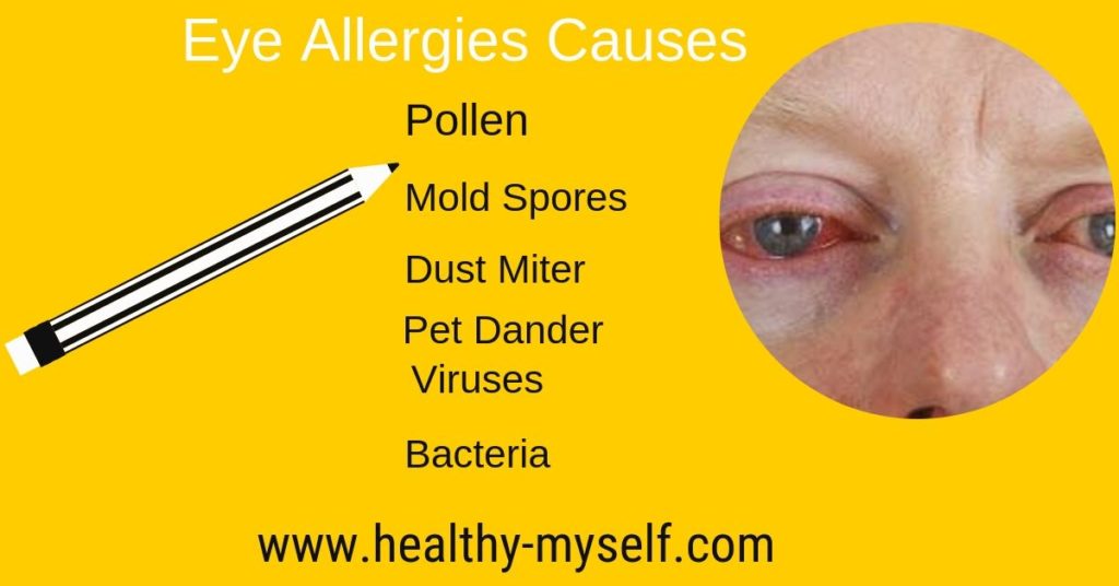 Eye Itching -Eye Allergy-Causes... Healthy-myself.com