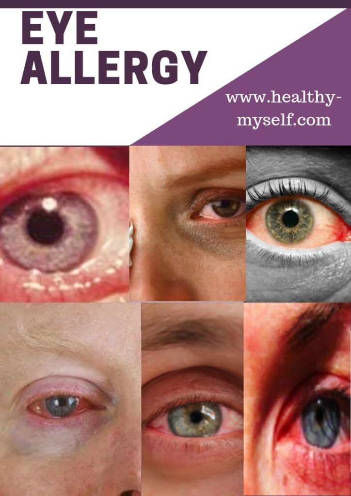 Eye Allergy-Picture- Healthy-myself.com
