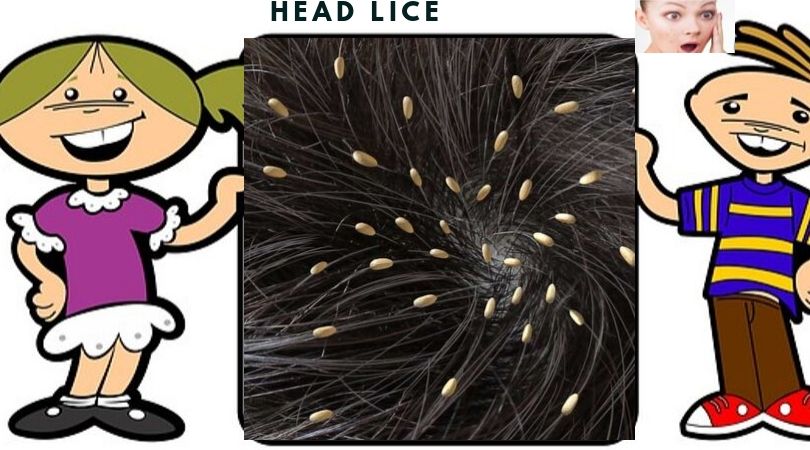 What is-Head Lice... healthy-myself.com