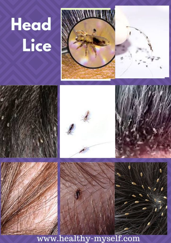 Head Lice  Pictures... healthy-myself.com