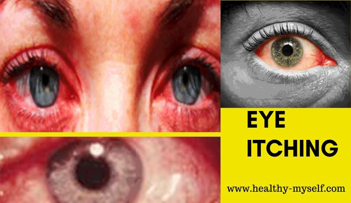 Eye Itching:Eye Itching Symptoms,Natural Relief & Home Remedies-2020