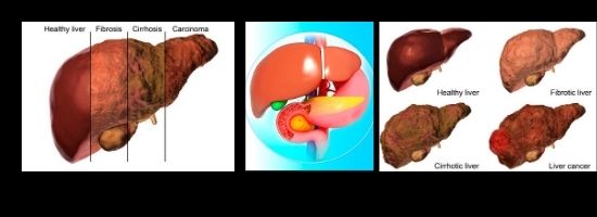 Liver Disease & Symptoms Healthy-myself.com
